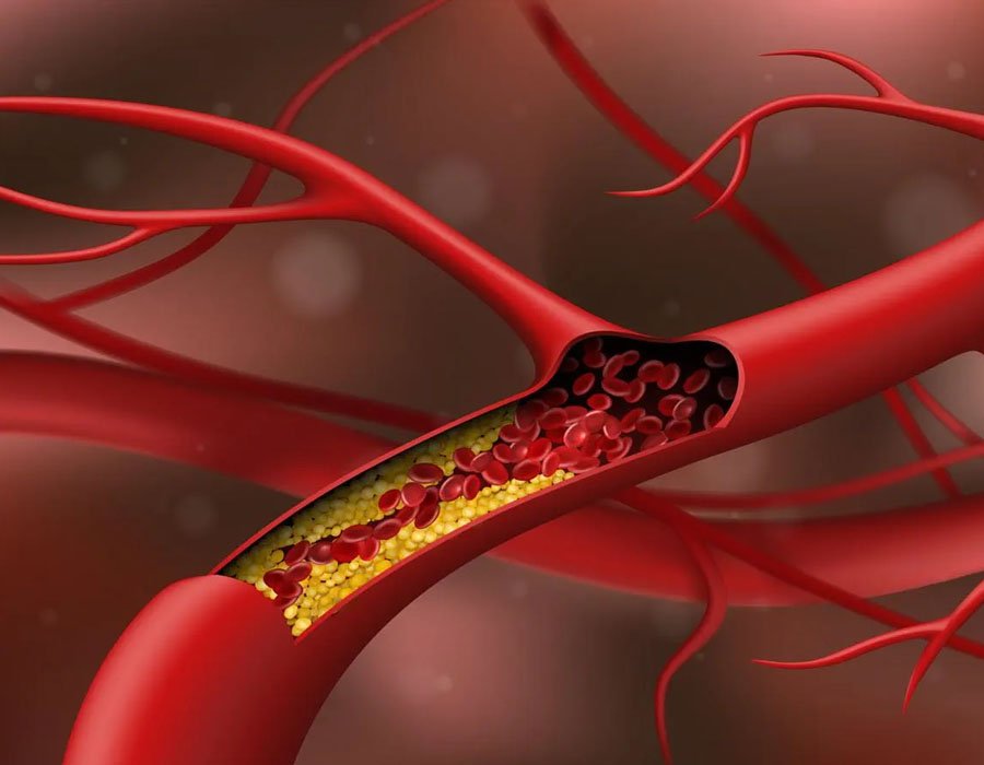 Lower your high cholesterol