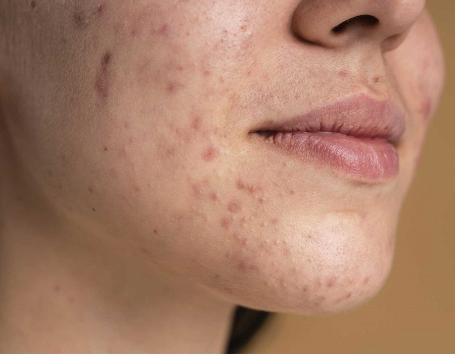 acne-treatment